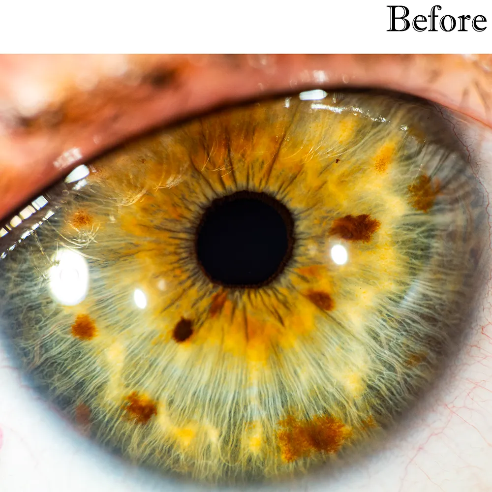 Iris photo__Before Iris photo__Before